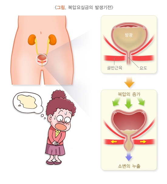 요실금 2.jpg